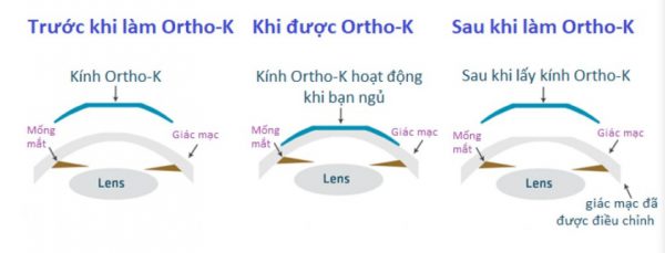 kính ortho-k