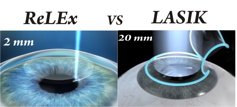 Лазерная коррекция зрения 2024. Лазерная коррекция зрения Femto ласик. Лазерная коррекция методом Фемто ласик. Операция Femto LASIK И smile. Лазерная коррекция зрения Фемто супер ласик.