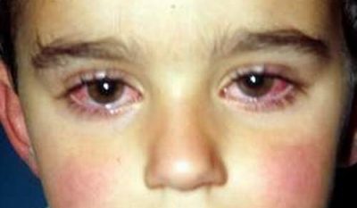 Viêm kết mạc mùa xuân là một bệnh do dị ứng ở mắt.