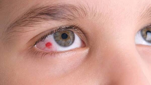 Hiện tượng chảy máu trong mắt thường không có gì nguy hiểm