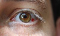 Mạch máu nhỏ dưới mắt bị vỡ có thể do những yếu tố gì?
