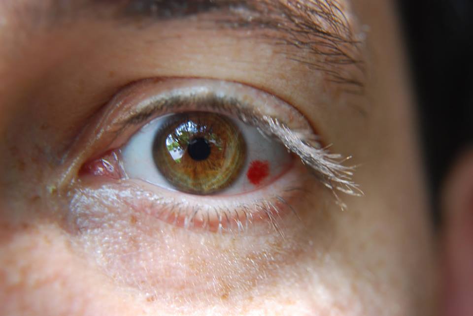 Tụ máu ở mắt khiến mắt xuất hiện những mảng đỏ