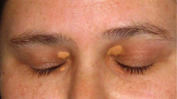 Bệnh u vàng ở mi mắt có những dấu hiệu vô cùng đặc trưng