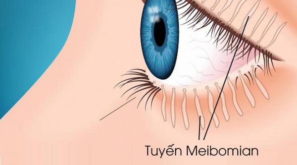 Tuyến Meibomius nawmg ở mi mắt có tác dụng giữ cho mắt không bị khô