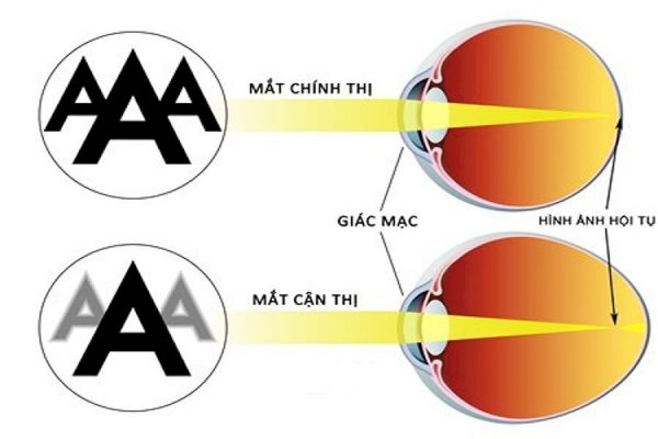 Điểm khác biệt giữa mắt bình thường và mắt bị cận thị