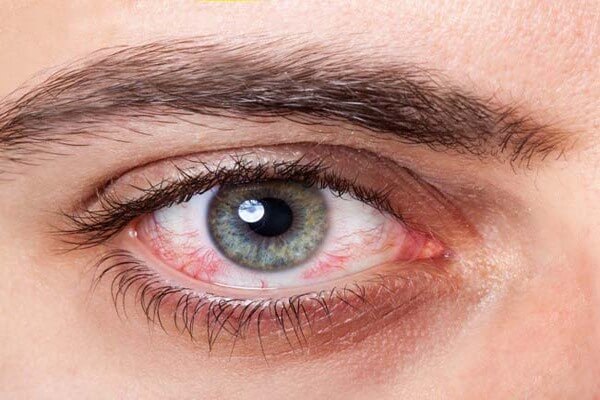 Không chỉ có các bệnh về mắt các căn bệnh khác nếu biến chứng sang mắt cũng có thể gây nên tình trạng này