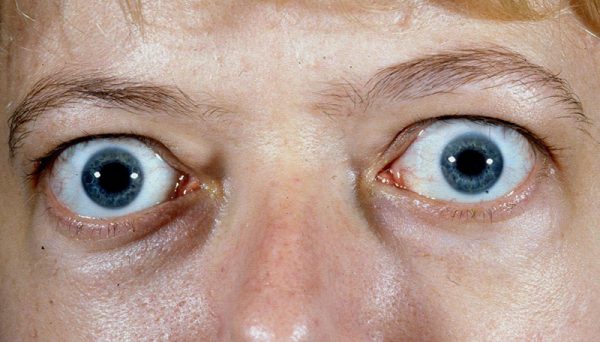Với mắt bình thường, không nhìn thấy phần lòng trắng nằm giữa đỉnh mống mắt và mi trên, nhưng mắt lồi thì phần lòng trắng lồi ra rất rõ.