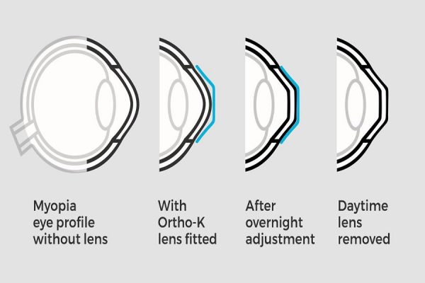 kính áp tròng ban đêm Ortho-K