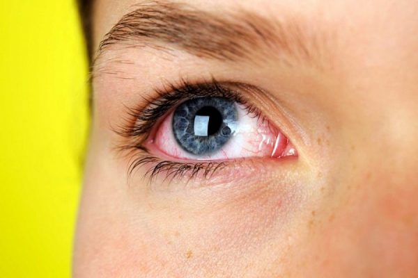 Khô mắt là nguyên nhân dẫn đến song thị một mắt