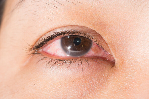 viêm loét giác mạc có thể dẫn đến mù