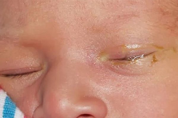 Viêm túi lệ bẩm sinh gây ra tình trạng mắt tiết nhiều gỉ, mí mắt đóng váng ở trẻ sơ sinh