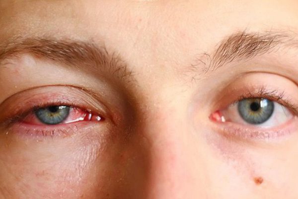 Mắt đỏ, cộm ngứa, chảy nhiều nước mắt – Những triệu chứng điển hình của bệnh đau mắt đỏ