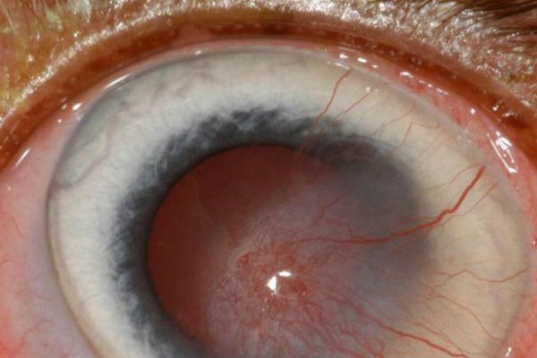 Đau mắt đỏ có thể gây ra các biến chứng viêm loét giác mạc thậm chí là mù lòa