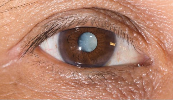 Bệnh cườm mắt là tên gọi chung của hai bệnh cườm khô và cườm nước