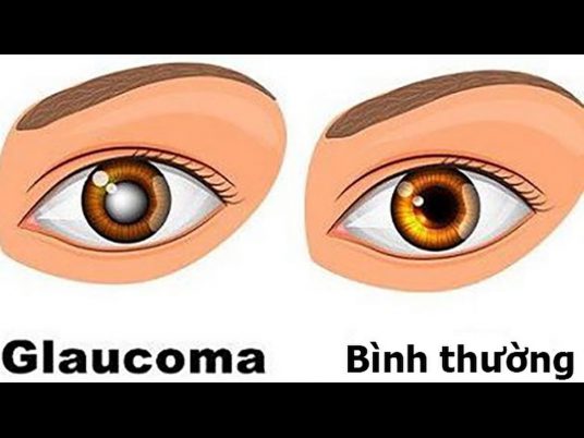 Tên gọi thường được biết đến của bệnh cườm nước là bệnh glaucoma, thiên đầu thống hay chứng tăng nhãn áp