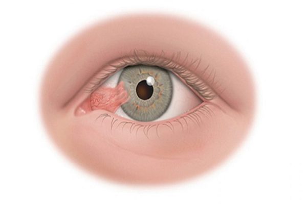 Bệnh nhân mắc khối u ở mắt, ung thư mắt, phẫu thuật loại bỏ mắt bị bệnh nhằm bảo toàn tính mạng cho người bệnh