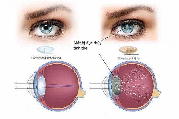 Đục thủy tinh thể chính là một trong những biến chứng đang nguy ngại nhất của việc viêm mống mắt