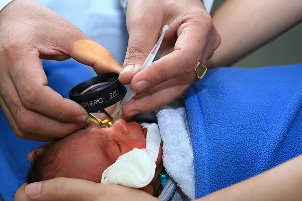 Bệnh võng mạc ở trẻ sinh non là tình trạng rối loạn mắt