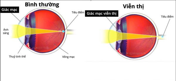Hình ảnh so sánh giữa mắt bình thường và mắt viễn thị