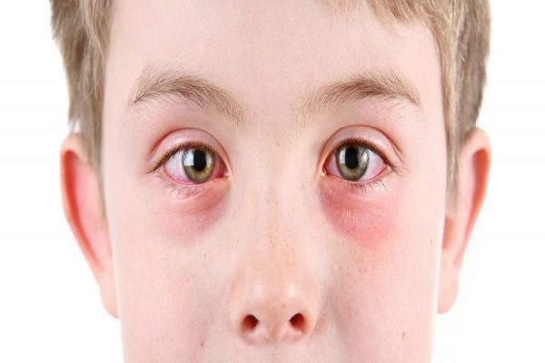 Viêm kết mạc là một trong những nguyên nhân gây ra tình trạng mắt nhìn xa bị nhòe