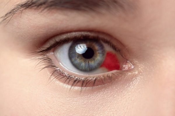 Đau, đỏ mắt, nhìn mờ… là những dấu hiệu nhận biết của xuất huyết võng mạc