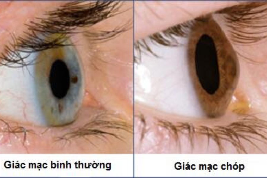 Các sợi protein nhỏ trong mắt suy yếu, làm giác mạc không còn ở đúng vị trí và dẫn tới bệnh giác mạc hình chóp
