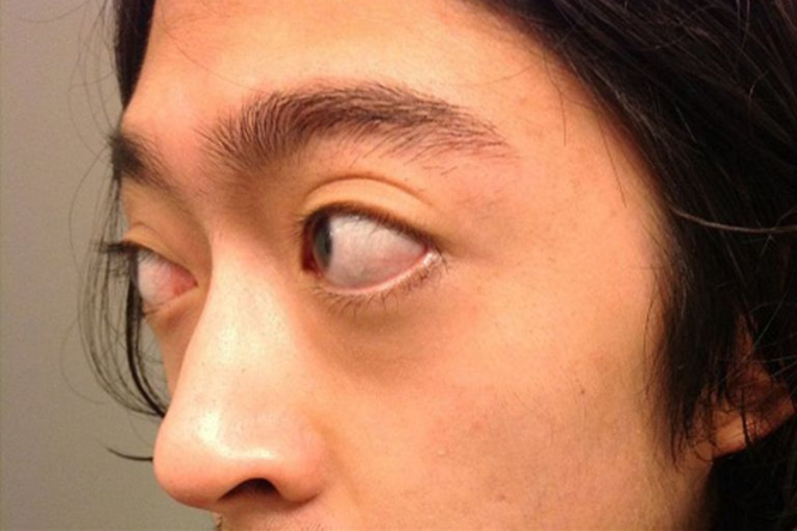 Mắt lồi là một trong những triệu chứng khi mắc u hốc mắt