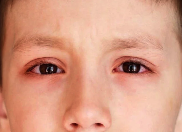 Đau mắt đỏ ở trẻ em là một trong những loại bệnh lý về mắt khá phổ biến